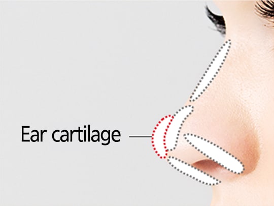 Simple Rhinoplasty Surgery Method (Ear Cartilage)